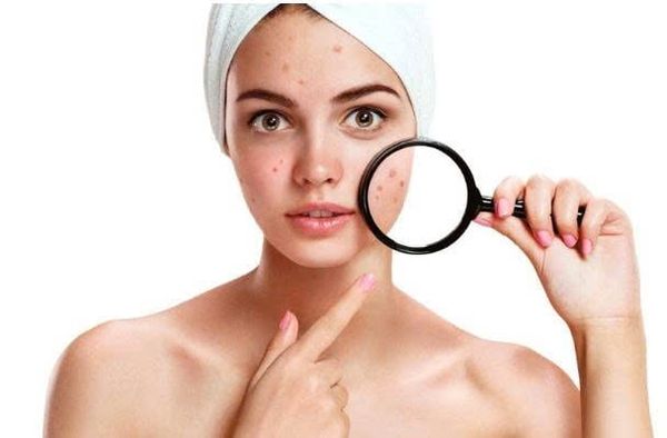 MỤN NỘI TIẾT CÓ THỂ XẢY RA Ở MỌI LỨA TUỔI VÀ ĐÂY LÀ CÁCH GIẢI QUYẾT