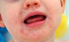 CHĂM SÓC TRẺ BỊ TAY CHÂN MIỆNG ĐÚNG CÁCH