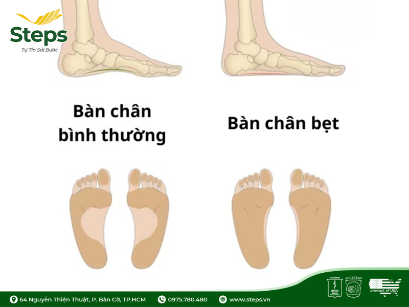 Bàn chân bẹt nên đi giày dép gì? Hướng dẫn lựa chọn giày dép phù hợp
