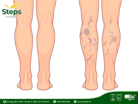5 bài tập cho người suy giãn tĩnh mạch chi dưới
