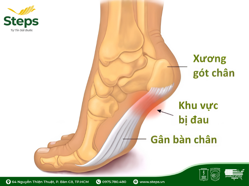 Viêm cân gan chân và đau gót chân khác nhau thế nào?