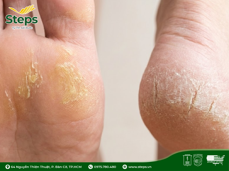 Chai chân, nứt gót chân: Nguyên nhân và cách chăm sóc tại nhà