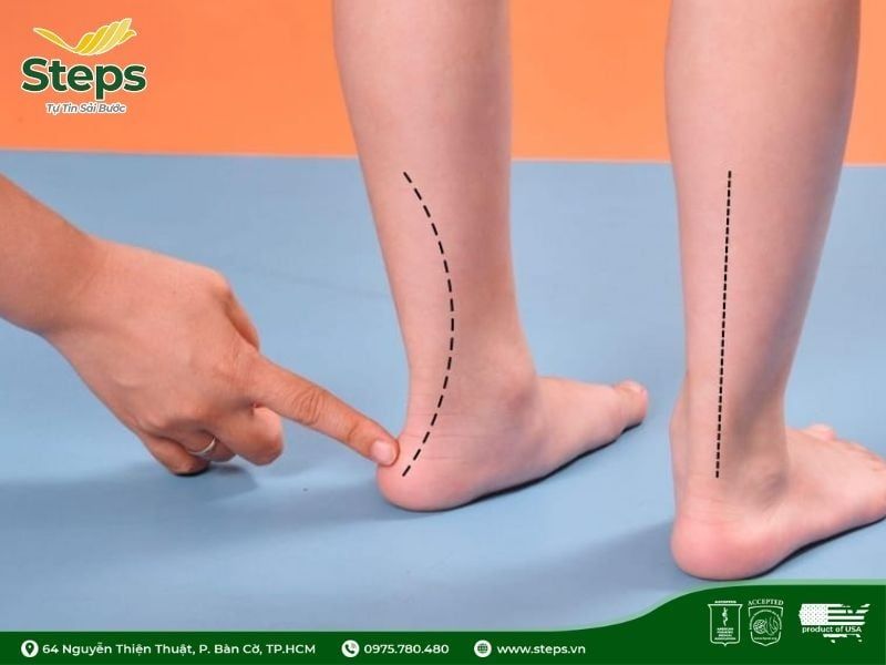 Bàn chân bẹt là gì: Nguyên nhân, dấu hiệu nhận biết, giải pháp hỗ trợ