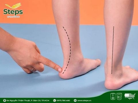 Bàn chân bẹt là gì: Nguyên nhân, dấu hiệu nhận biết, giải pháp hỗ trợ