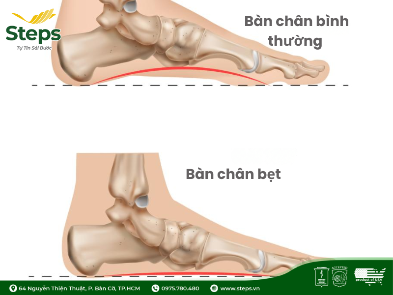 Dấu hiệu nhận biết bàn chân bẹt tại nhà chỉ trong 1 phút