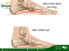 Dấu hiệu nhận biết bàn chân bẹt tại nhà chỉ trong 1 phút