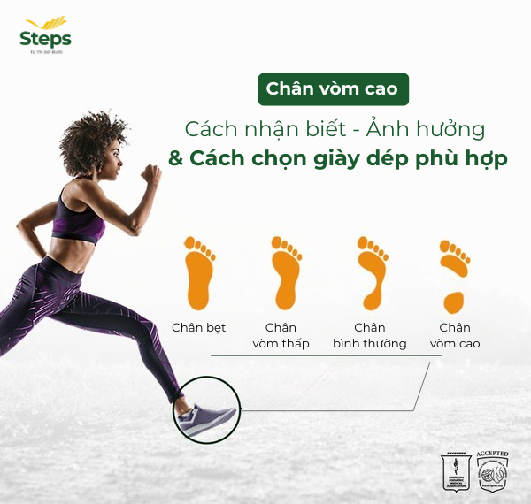 Chân vòm cao: Dấu hiệu, nguyên nhân, ảnh hưởng và giải pháp hỗ trợ cải thiện hiệu quả