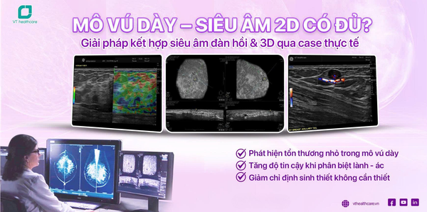 Case lâm sàng thực tế: Ứng dụng siêu âm 2D kết hợp đàn hồi và siêu âm 3D trong chẩn đoán u nhú trong ống tuyến vú
