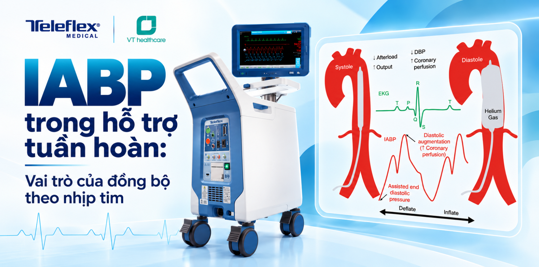 IABP trong hỗ trợ tuần hoàn: Vai trò của đồng bộ theo nhịp tim