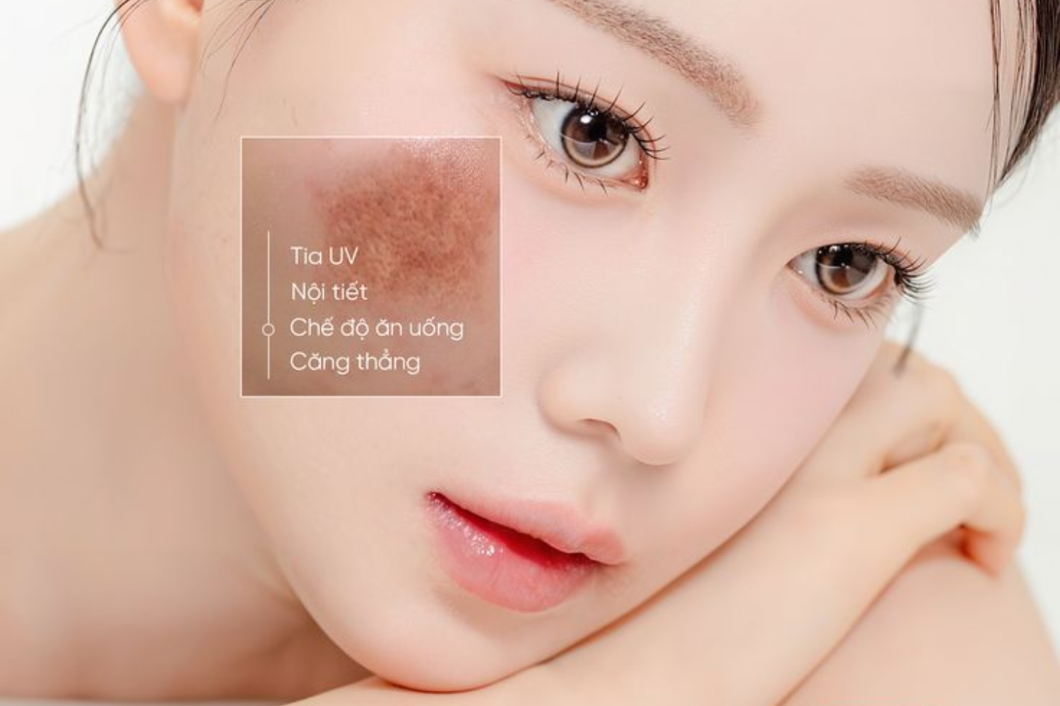 Nám Da Từ Đâu Mà Có? 5 Nguyên Nhân Khiến Da Ngày Càng Sạm Màu!