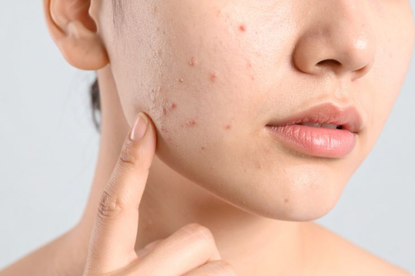 Vì Sao Bạn Bị Mụn Dù Đã Skincare Đều? 7 Nguyên Nhân Nhiều Người Bỏ Qua