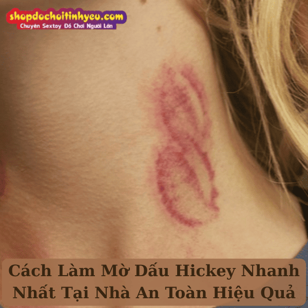 Cách Làm Mờ Dấu Hickey Nhanh Nhất Tại Nhà An Toàn Hiệu Quả