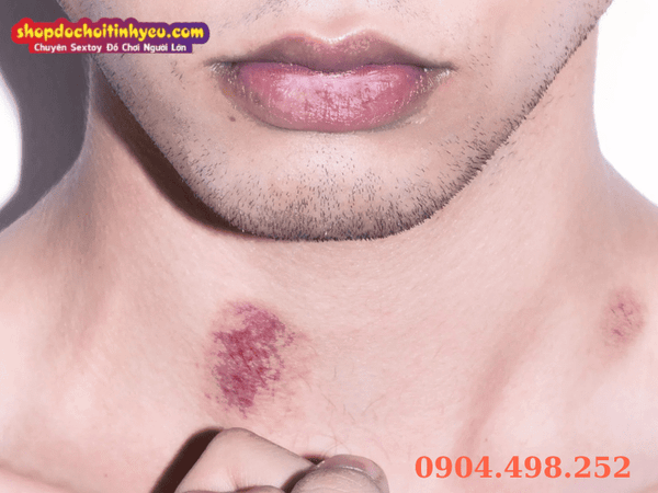 Tổng hợp cách làm mờ dấu hickey nhanh tại nhà