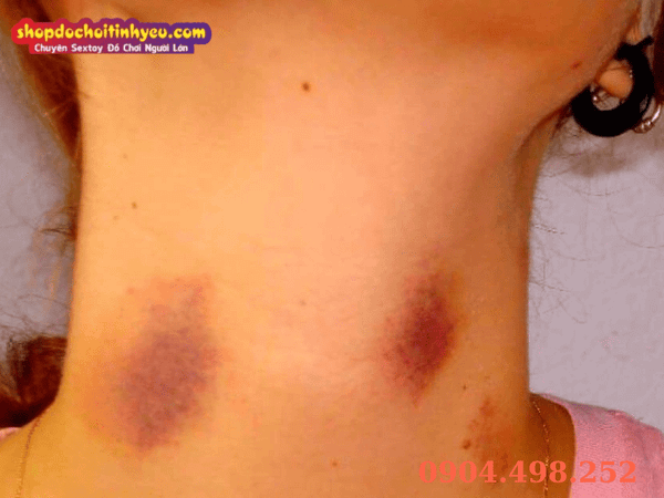 Cách làm mờ dấu hickey an toàn và thần tốc