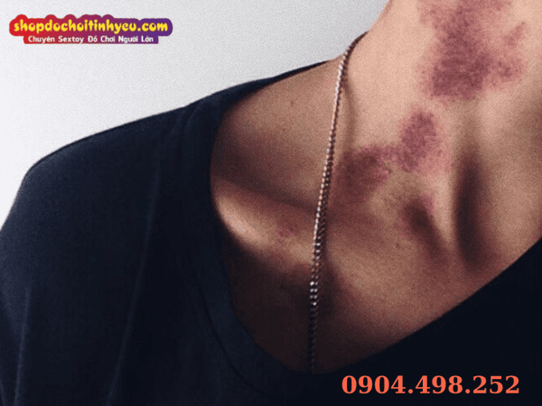 Hickey là gì và chu trình tan bầm tự nhiên