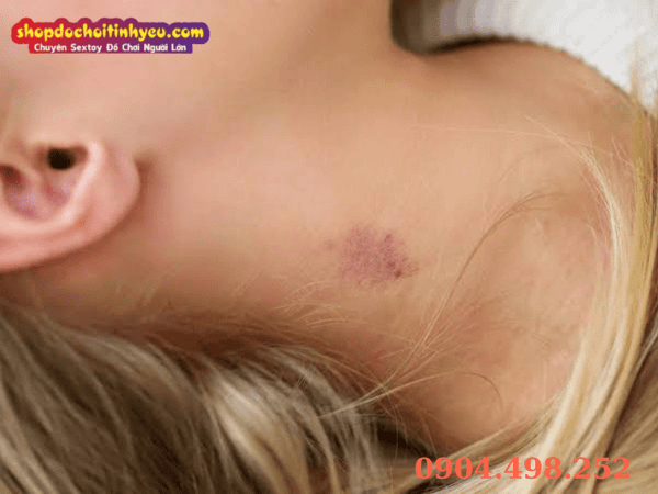 Giải đáp thắc mắc thường gặp về dấu hickey