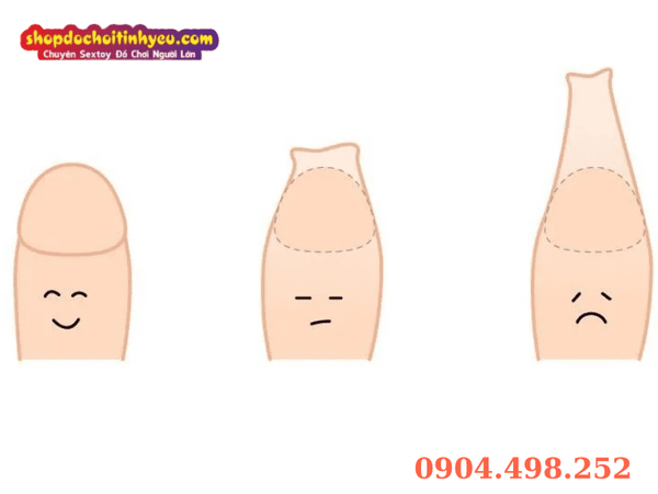 Các bệnh lý thường gặp ở rãnh bao quy đầu