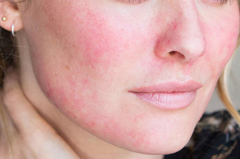 Da nhạy cảm với treatment – bí kíp phục hồi nhanh