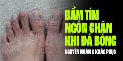 BẦM TÍM NGÓN CHÂN KHI ĐÁ BÓNG: NGUYÊN NHÂN VÀ CÁCH KHẮC PHỤC TRIỆT ĐỂ