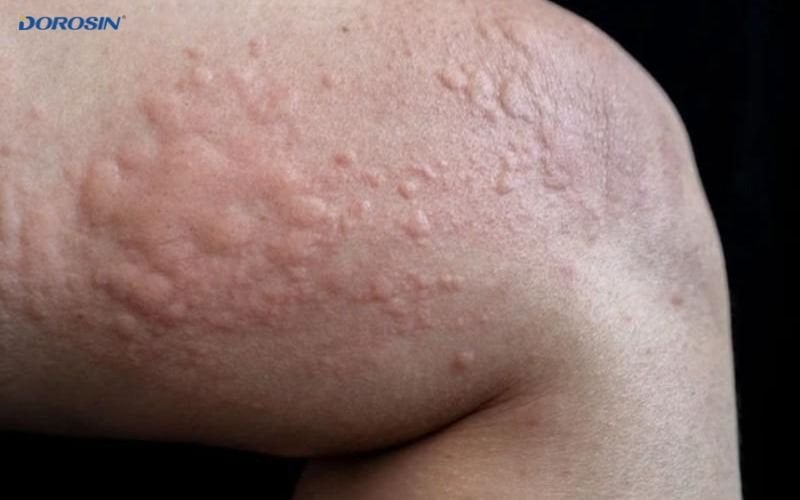cách chữa dị ứng thời tiết 1