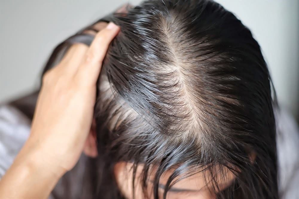 Tóc mỏng, lộ da đầu khiến nhiều chị em phiền lòng