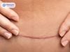 Bị Vết Thương Kiêng Ăn Gì Để Không Bị Sẹo? 7 Bí Mật Khoa Học