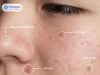 Cách trị mụn ẩn: Sai lầm skincare khiến da bí và nổi mụn nhiều hơn