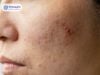 Cách Dùng Kem Trị Thâm Mụn Để Da Sáng Mịn Sau 2 Tuần