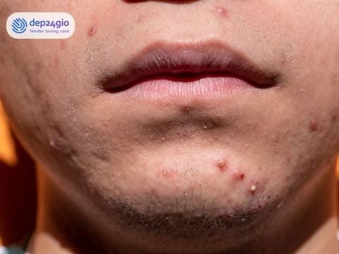 Mụn Viêm Ở Cằm: Có Nên Nặn Và Chăm Sóc Thế Nào?