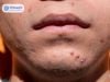 Mụn Viêm Ở Cằm: Có Nên Nặn Và Chăm Sóc Thế Nào?
