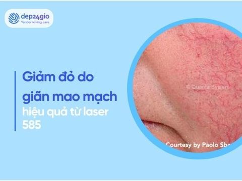 Giảm đỏ do giãn mao mạch ở mặt hiệu quả