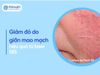 Giảm đỏ do giãn mao mạch ở mặt hiệu quả