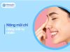 Nâng mũi chỉ – Giải pháp nâng mũi tự nhiên, không phẫu thuật