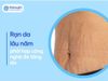 Công nghệ mới trị rạn da lâu năm – Hiệu quả gấp 3 lần