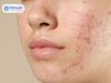 Top 5 kem trị thâm mụn giá bình dân đáng thử