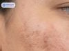 Top 6 kem trị nám tốt nhất: Chọn đúng theo cơ chế nám