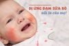 Dị Ứng Đạm Sữa Bò Ở Trẻ Sơ Sinh: Dấu Hiệu, Nguyên Nhân Và Cách Xử Lý