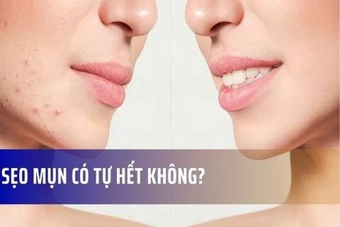Sẹo mụn có tự hết không?