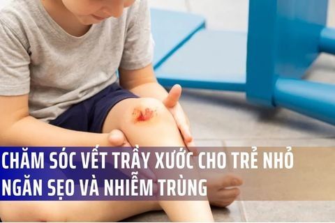 Chăm Sóc Vết Thương Trầy Xước Cho Trẻ Nhỏ Đúng Cách – Ngăn Sẹo Và Nhiễm Trùng Hiệu Quả