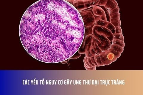 Các Yếu Tố Nguy Cơ Gây Ung Thư Đại Trực Tràng