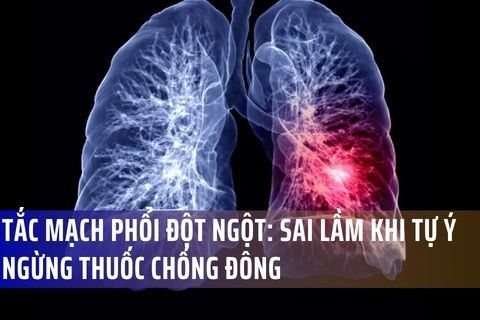 Hiểm Họa Tắc Mạch Phổi Đột Ngột: Sai Lầm Chết Người Khi Tự Ý Ngừng Thuốc Chống Đông