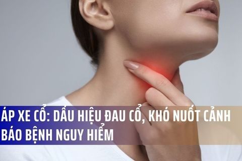 Áp Xe Cổ: Dấu Hiệu Đau Cổ, Khó Nuốt Cảnh Báo Bệnh Nguy Hiểm