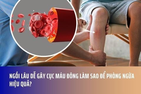 Ngồi Lâu Dễ Gây Cục Máu Đông Làm Sao Để Phòng Ngừa Hiệu Quả?