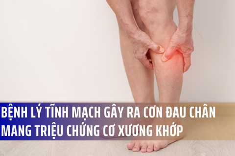 Các Bệnh Lý Tĩnh Mạch Gây Ra Cơn Đau Chân Mang Triệu Chứng Cơ Xương Khớp