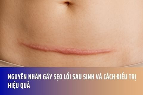 NGUYÊN NHÂN GÂY SẸO LỒI SAU SINH VÀ CÁCH ĐIỀU TRỊ HIỆU QUẢ