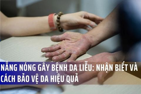 Nắng Nóng Đầu Mùa Làm Bùng Phát Bệnh Da Liễu: Cách Phòng Tránh Hiệu Quả