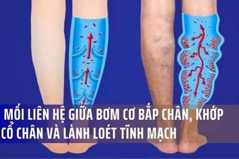 Mối Liên Hệ Giữa Bơm Cơ Bắp Chân, Khớp Cổ Chân và Lành Loét Tĩnh Mạch