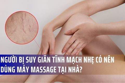Người bị suy giãn tĩnh mạch nhẹ có nên dùng máy massage (máy xoa bóp) tại nhà?