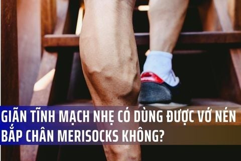 Giãn tĩnh mạch nhẹ có dùng được vớ nén bắp chân Merisocks không?