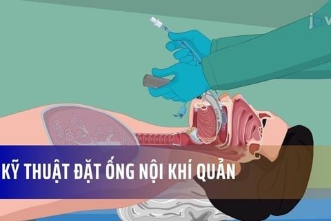 Kỹ Thuật Đặt Ống Nội Khí Quản